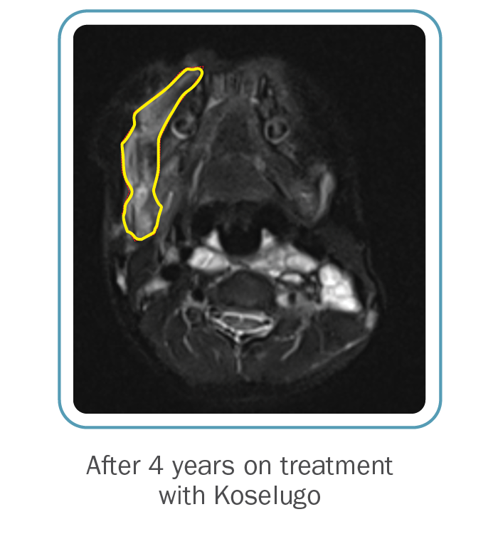 Patient case study: MRI showing results before and after treatment with Koselugo