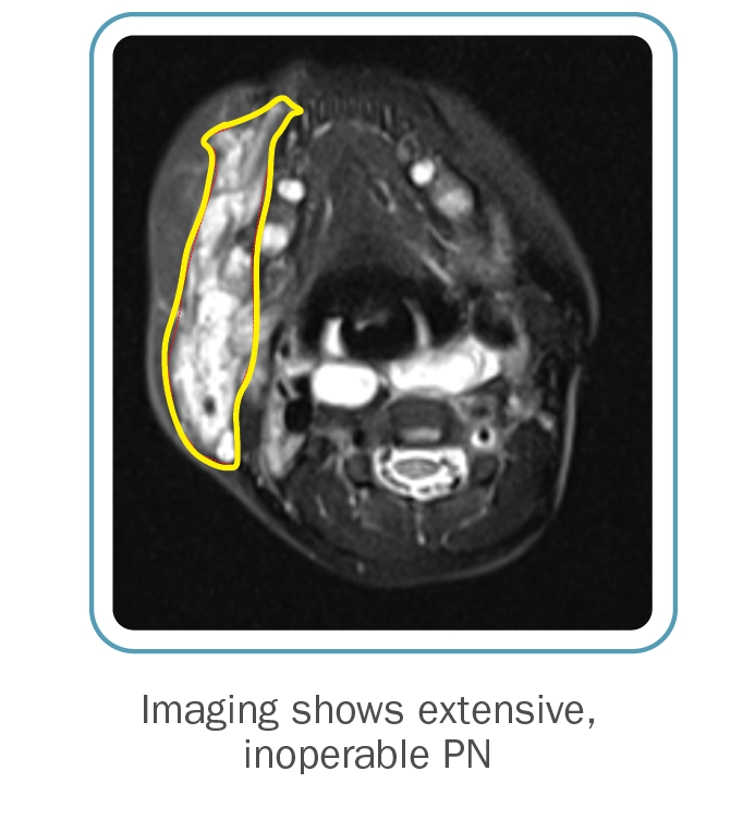 Patient case study: MRI showing results before and after treatment with Koselugo